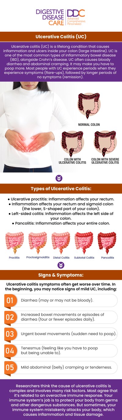 Ulcerative colitis is an inflammatory bowel disease that causes symptoms such as abdominal pain, cramping, and frequent diarrhea, often with blood or mucus in the stool. Other common signs include weight loss, fatigue, and an urgent need to use the bathroom. If you experience these symptoms, it’s important to consult Dr. Preeti Mehta and our board-certified team of gastroenterologists at Digestive Disease Care for proper evaluation and treatment. For more information, please contact us or book an appointment online. We have convenient locations to serve you in Babylon NY, East Setauket NY, Forest Hills NY, Jericho NY, Lake Success NY, Melville NY, Mineola NY, Massapequa NY, New Hyde Park NY and Riverhead NY.